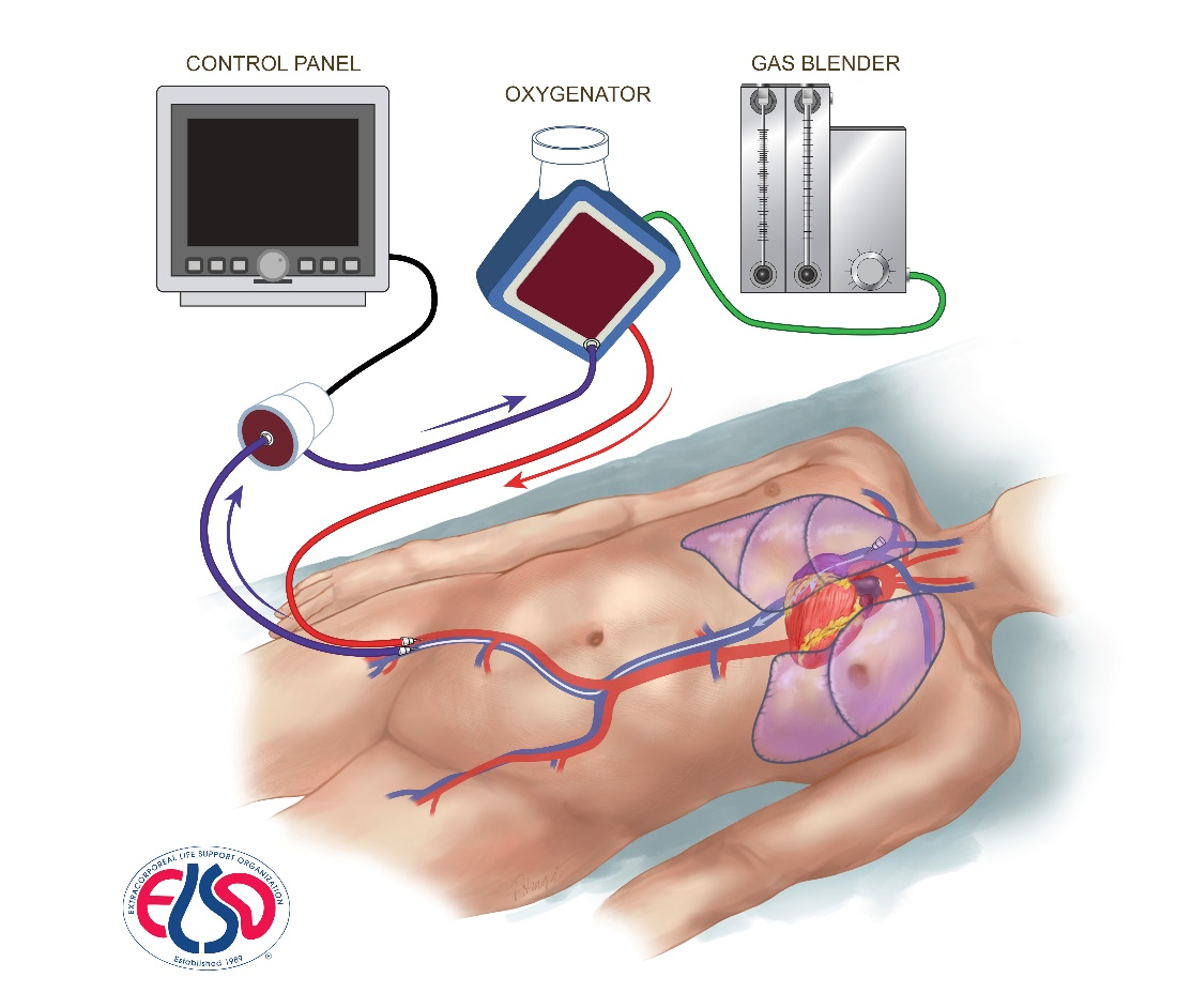 ECMO configuration diagram